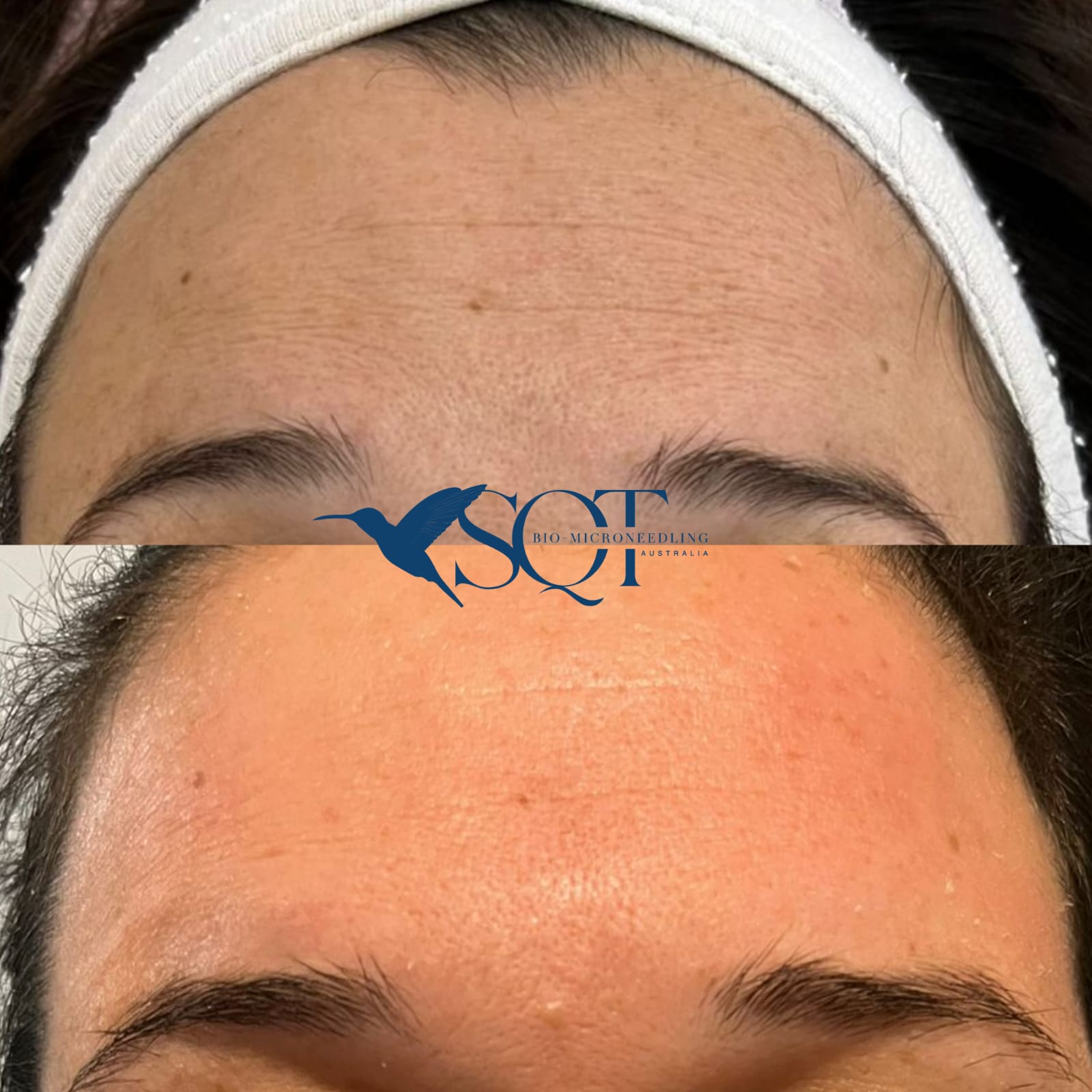 SQT Treatment at Allure Skin and Beauty