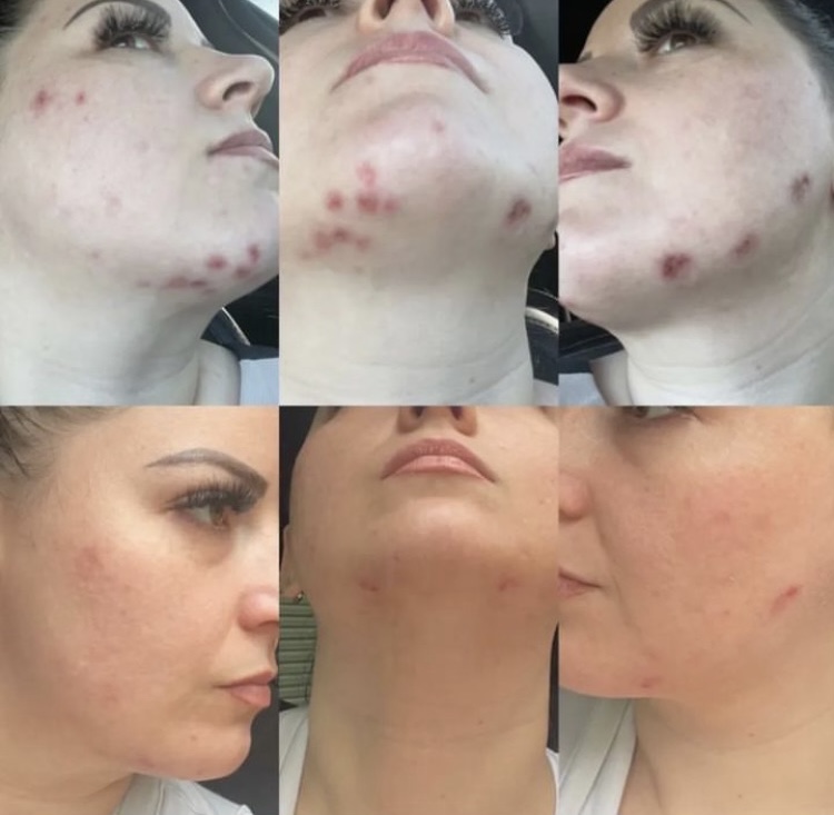 SQT Before and After Acne Treatment