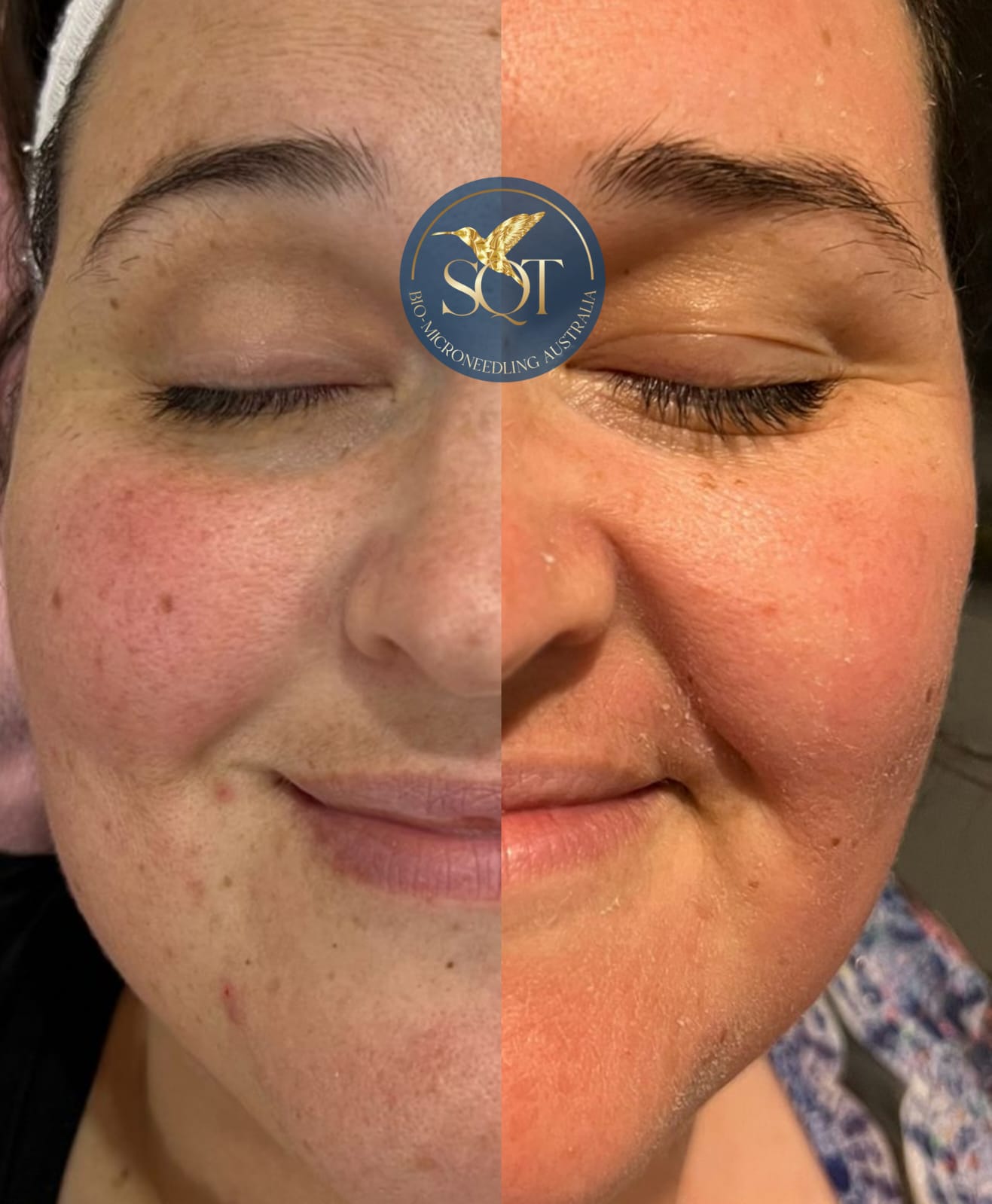 SQT Before After Treatment